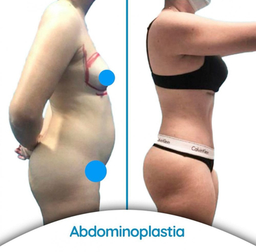 Slider image (7) Dr. Alvaro Uribe - Plastic Surgery in Colombia